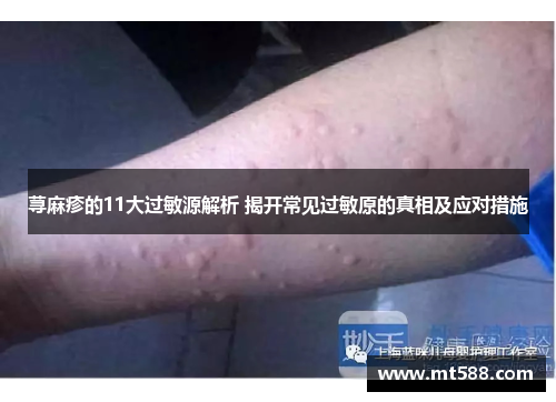 荨麻疹的11大过敏源解析 揭开常见过敏原的真相及应对措施